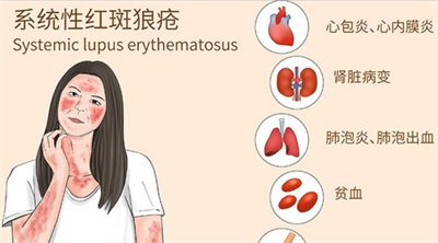 环境因素如何“点燃”狼疮？